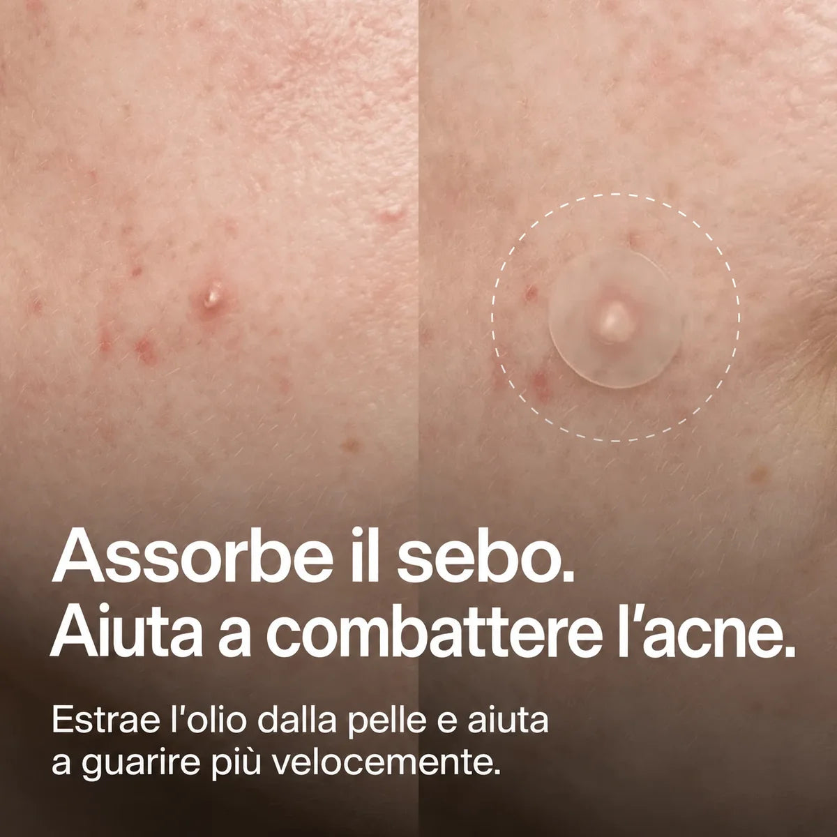 Cerotti Idrocolloidali per Brufoli